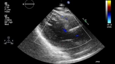 Transesophageal ultrasound video in gray-scale mode.