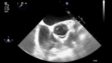 Transesophageal ultrasound video in gray-scale mode.