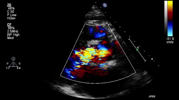 Transesophageal Ultrasound Video Doppler Mode — 비디오