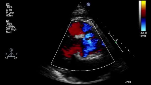 Vídeo Ultrasonido Transesofágico Modo Doppler — Vídeos de Stock