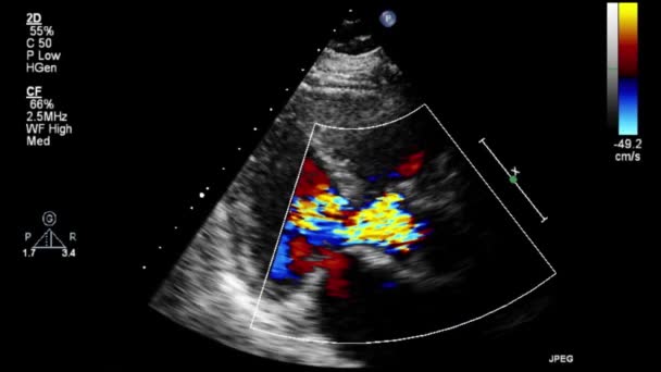 Transesofageale Echografie Video Doppler Modus — Stockvideo