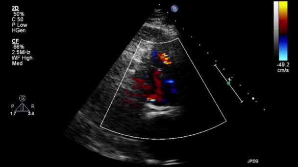 Transesophageal Ultrasound Video Doppler Mode — Stok video