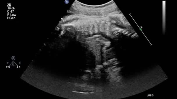 Fetal Kalbin Ultrason Muayenesi — Stok video