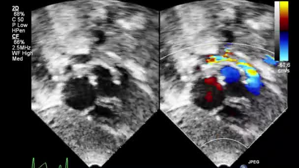 Transesophageales Ultraschallvideo Doppler Modus — Stockvideo