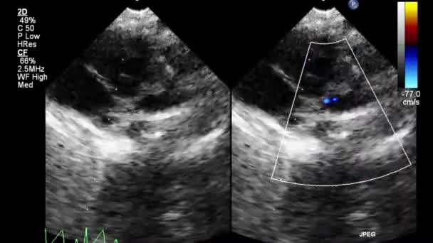 Transesophageal Ultrasound Video Gray Scale Mode — Stok video
