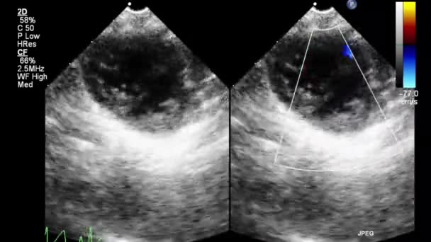 Transesophageal Ultrasound Video Gray Scale Mode — Stok video