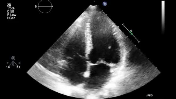 Transesophagales Ultraschallvideo Graustufen Modus — Stockvideo