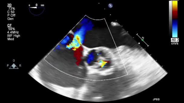 Vídeo Ultra Sonográfico Transesofágico Modo Doppler — Vídeo de Stock