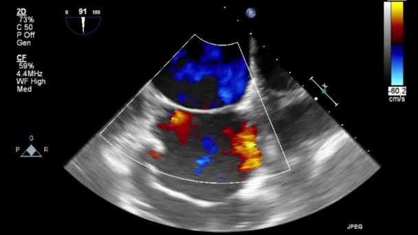 Vidéo Échographie Transœsophagienne Mode Doppler — Video