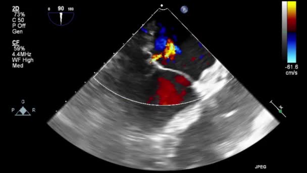 ドップラーモードでの経食道超音波ビデオ — ストック動画