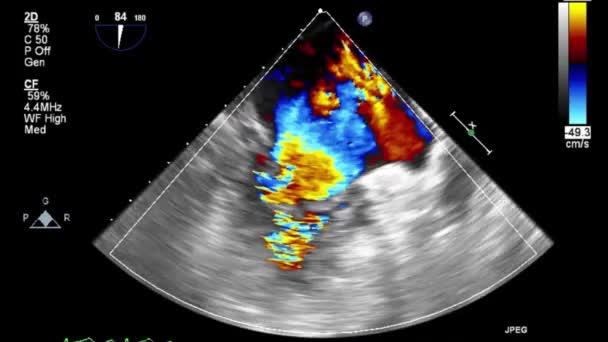 Vídeo Ultra Sonográfico Transesofágico Modo Doppler — Vídeo de Stock