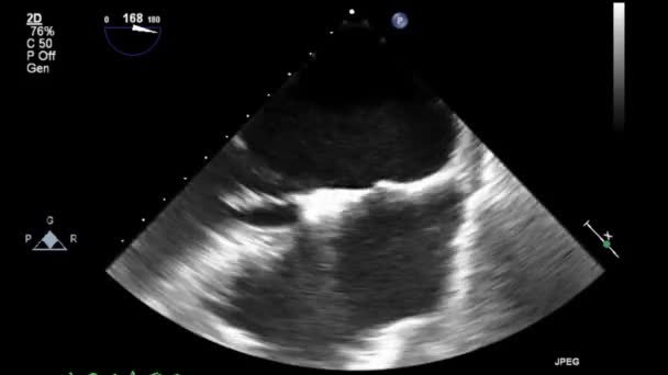 Transesofageální Ultrazvukové Video Šedém Měřítku — Stock video
