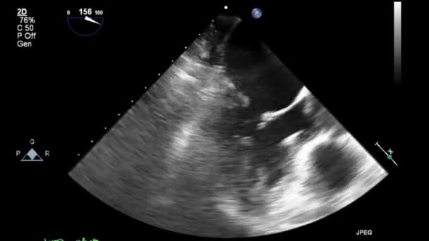 Transesofageální Ultrazvukové Video Šedém Měřítku — Stock video