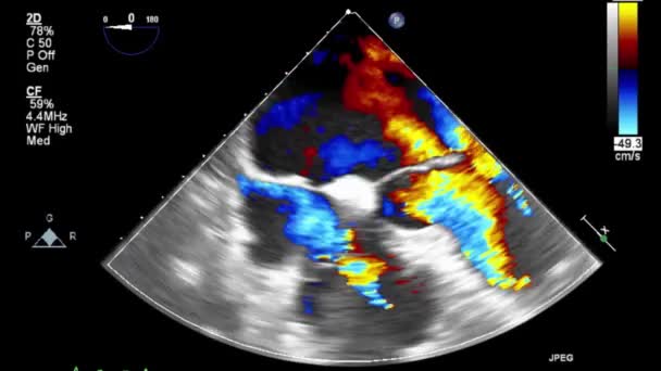 Transesophageal Ultrasound Video Doppler Mode — Stockvideo