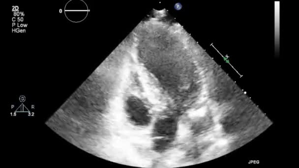 Transesophageal Ultrasound Video Gray Scale Mode — Stock Video