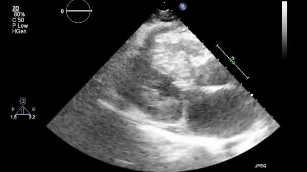 Transesophageal Ultrasound Video Gray Scale Mode — Stockvideo