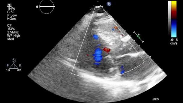 Vídeo Ultra Sonográfico Transesofágico Modo Doppler — Vídeo de Stock