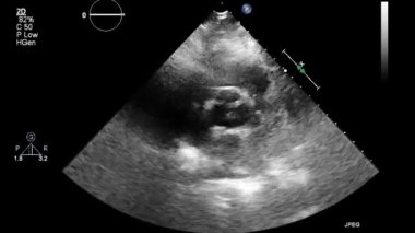 Kalbin ultrason transsofageal muayenesi.