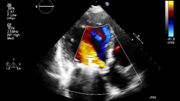 Ultraschall Transesophageale Untersuchung Des Herzens — Stockvideo