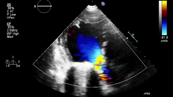 Echografie Transslokdarmonderzoek Van Het Hart — Stockvideo