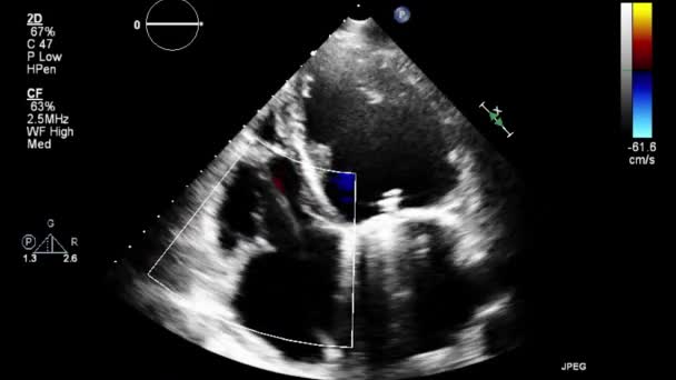 Echografie Transslokdarmonderzoek Van Het Hart — Stockvideo