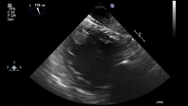 Ecografía Examen Transesofágico Del Corazón — Vídeos de Stock