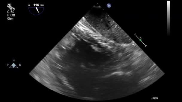 Ultrasound Transesophageal Examination Heart — Stock Video