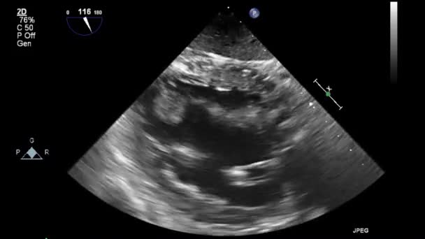 Ecografía Examen Transesofágico Del Corazón — Vídeos de Stock