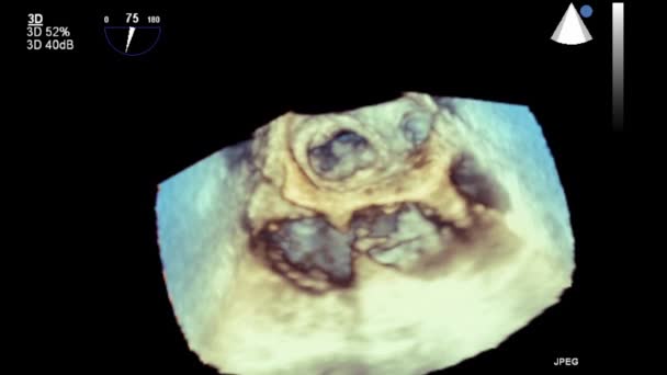 Ecografía Examen Transesofágico Del Corazón — Vídeo de stock