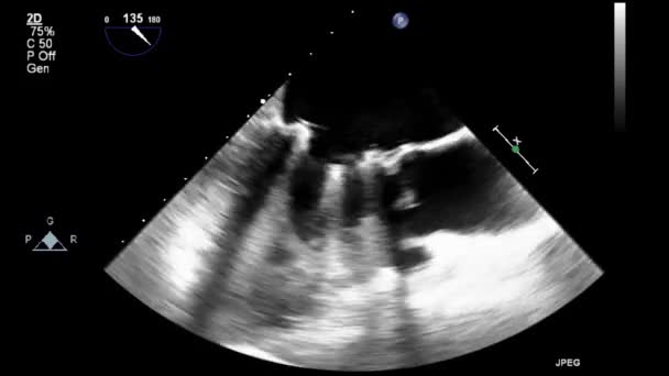 Ultrasound Transesophageal Examination Heart — Stock Video