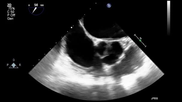 Ультразвуковое Трансофагеальное Исследование Сердца — стоковое видео