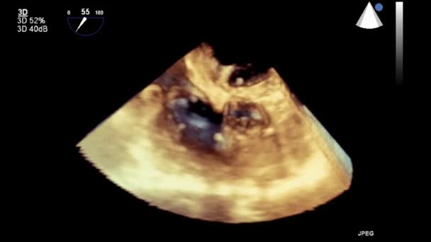 Ultrasound Transesophageal Pemeriksaan Jantung — Stok Video