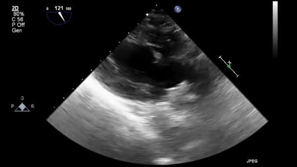 Ultralyd Transesophageal Undersøgelse Hjertet – Stock-video