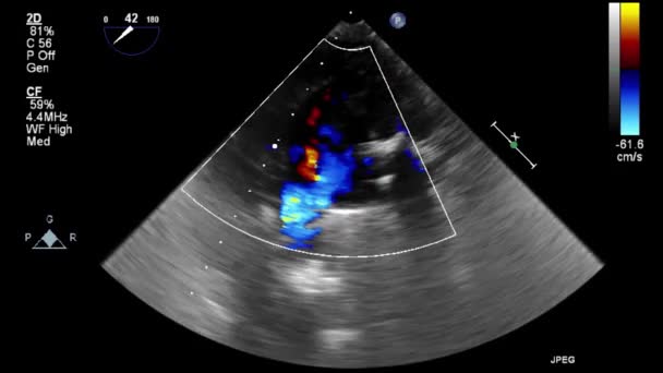 Ультразвуковое Трансофагеальное Исследование Сердца — стоковое видео
