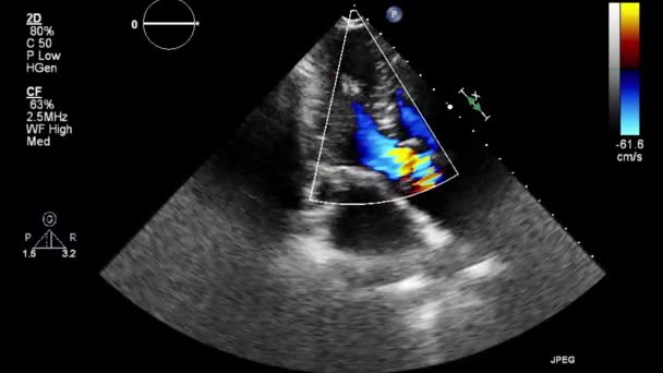 Ультразвуковое Трансофагеальное Исследование Сердца — стоковое видео