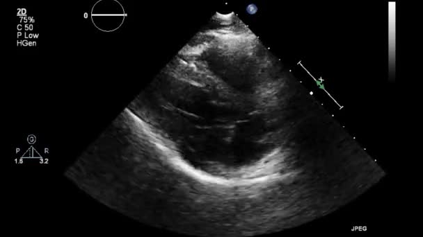 Echografie Transslokdarmonderzoek Van Het Hart — Stockvideo