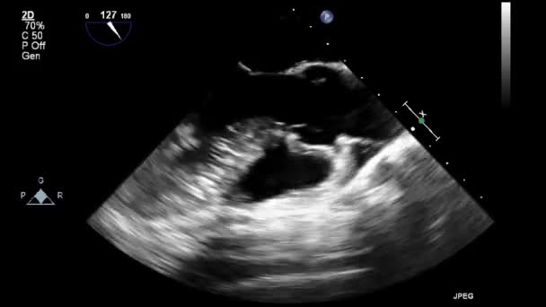 Exame Transesofágico Ultrassonográfico Coração — Vídeo de Stock