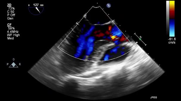 Ultrasound Transesophageal Examination Heart — Stock Video