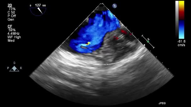 Ecografia Esame Transesofageo Del Cuore — Video Stock