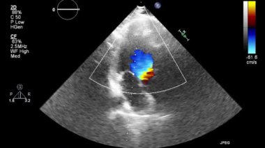 Kalbin ultrason transsofageal muayenesi.
