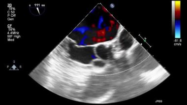 Kalbin ultrason transsofageal muayenesi.