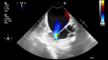 Kalbin ultrason transsofageal muayenesi.