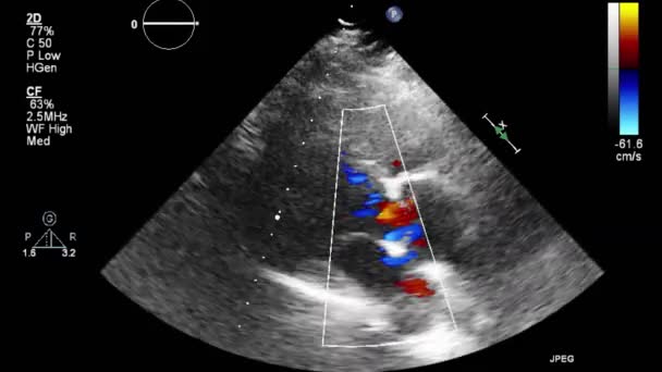 Ecografia Esame Transesofageo Del Cuore — Video Stock