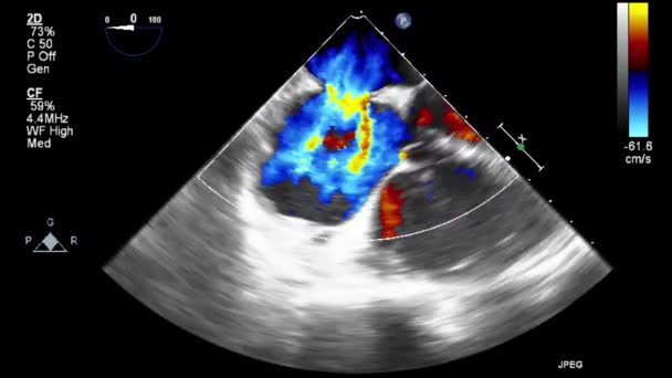 Ecografía Examen Transesofágico Del Corazón — Vídeos de Stock