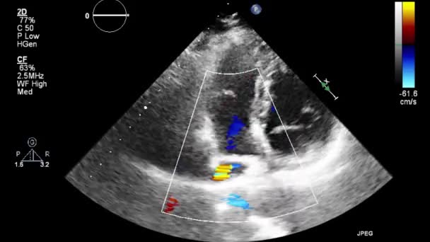 Ecografia Esame Transesofageo Del Cuore — Video Stock