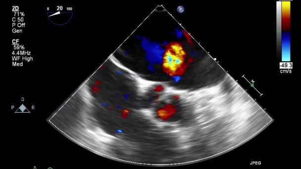 Ультразвуковое Трансофагеальное Исследование Сердца — стоковое видео