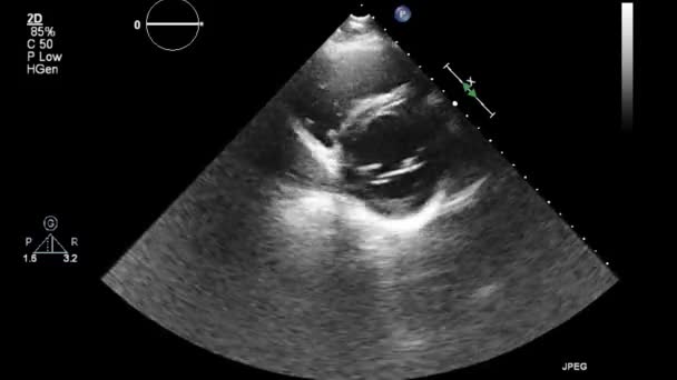 Ecografia Esame Transesofageo Del Cuore — Video Stock