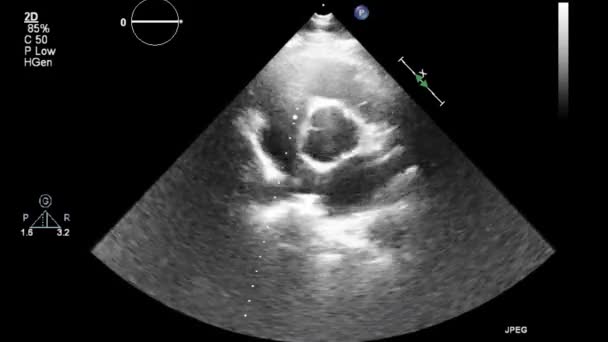 Ecografía Examen Transesofágico Del Corazón — Vídeos de Stock
