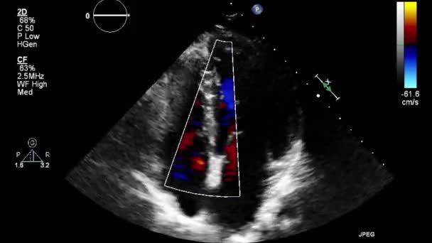 Ecografía Examen Transesofágico Del Corazón — Vídeos de Stock
