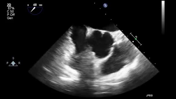 Echografie Transslokdarmonderzoek Van Het Hart — Stockvideo